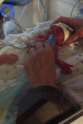 Teeny, tiny baby. The nurse is holding the tube up so she can breathe. They were in the middle of intubating her.